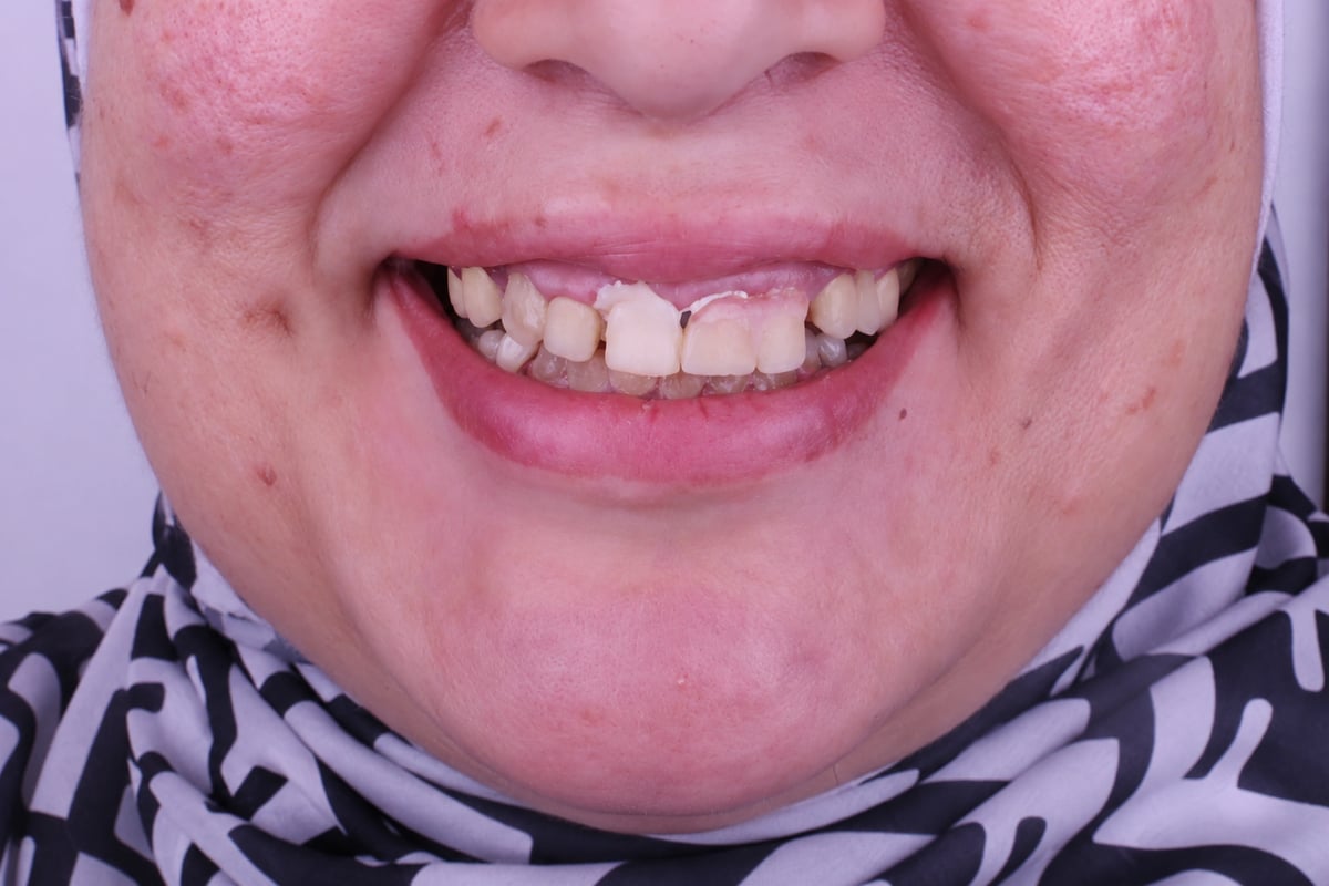 قبل - تجميل الابتسامة