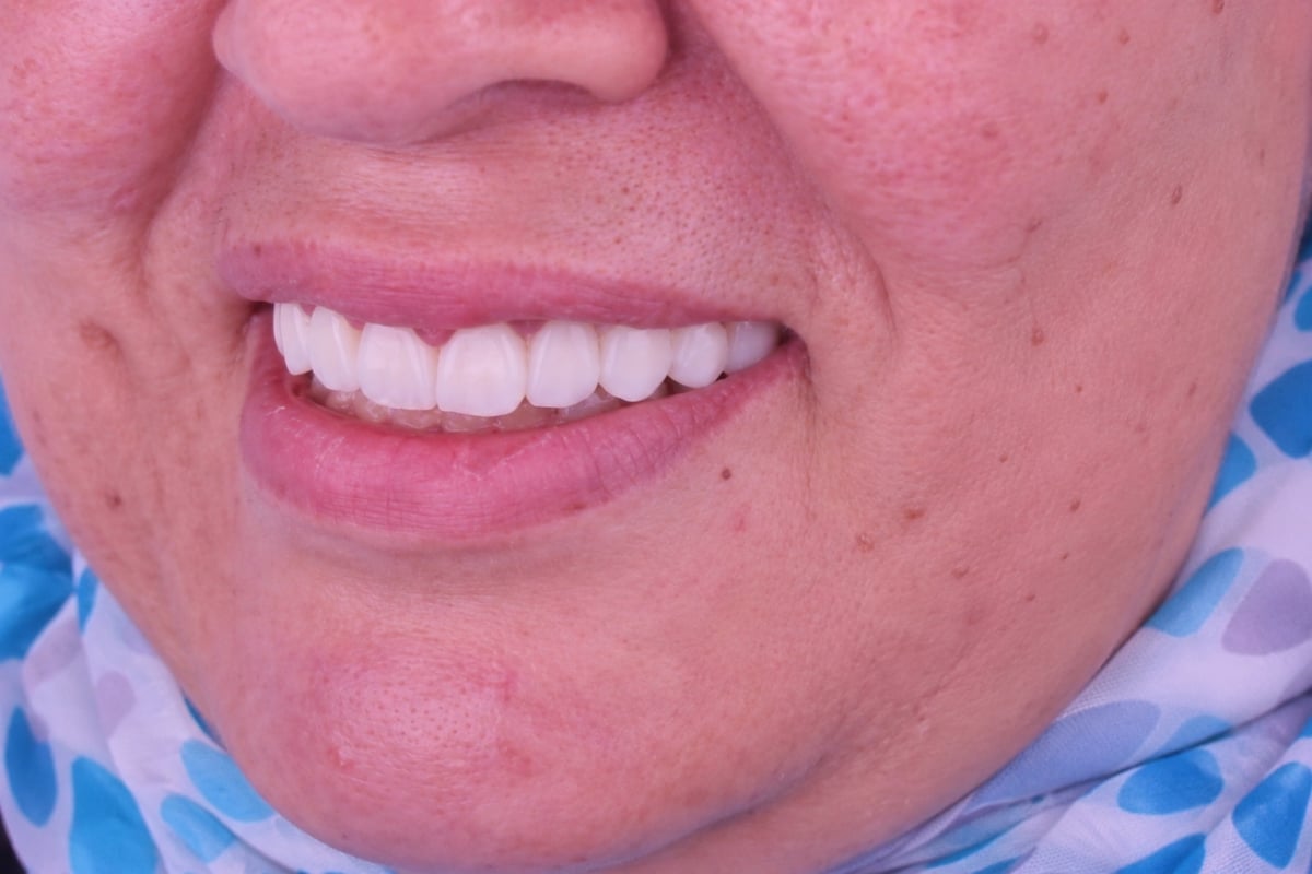 بعد - تجميل الابتسامة