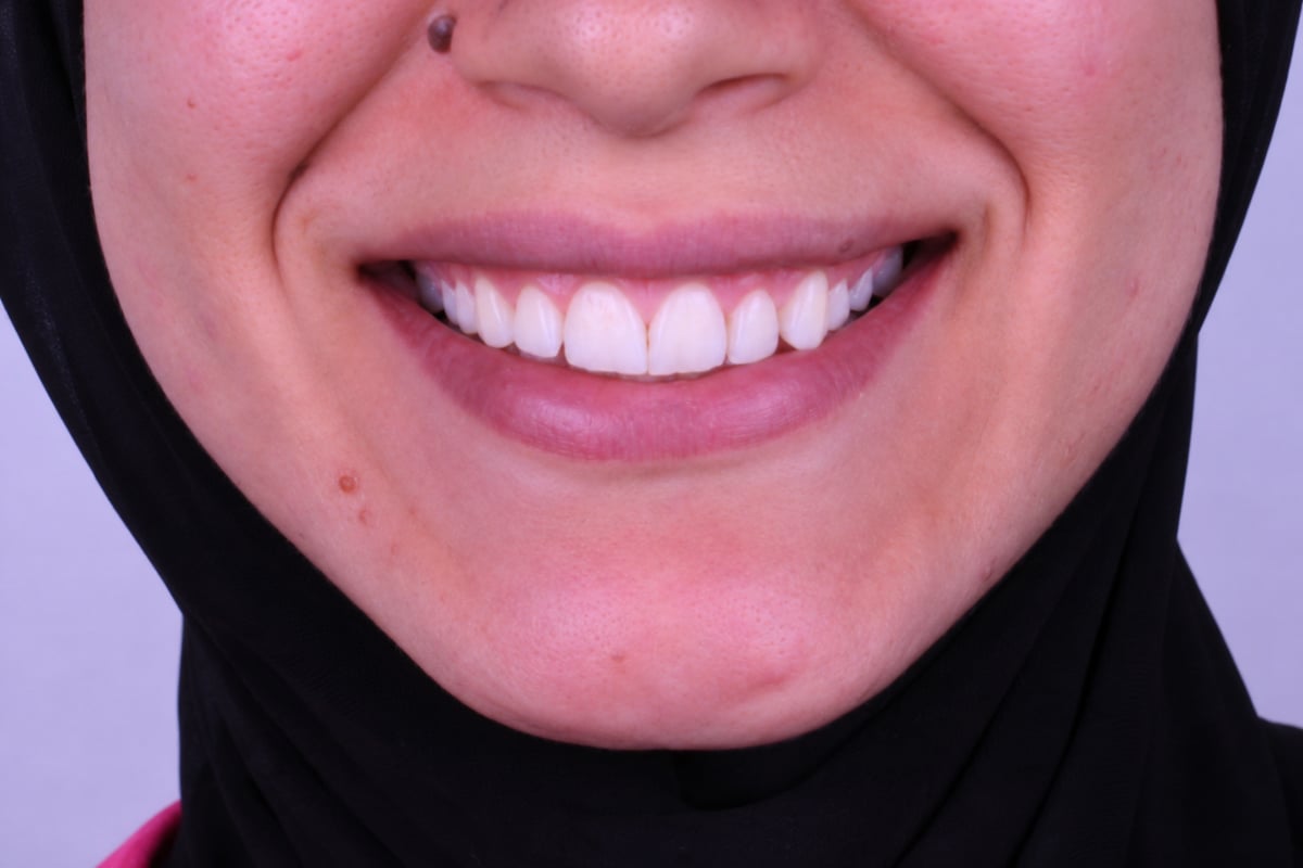 بعد - تجميل الأسنان الأمامية