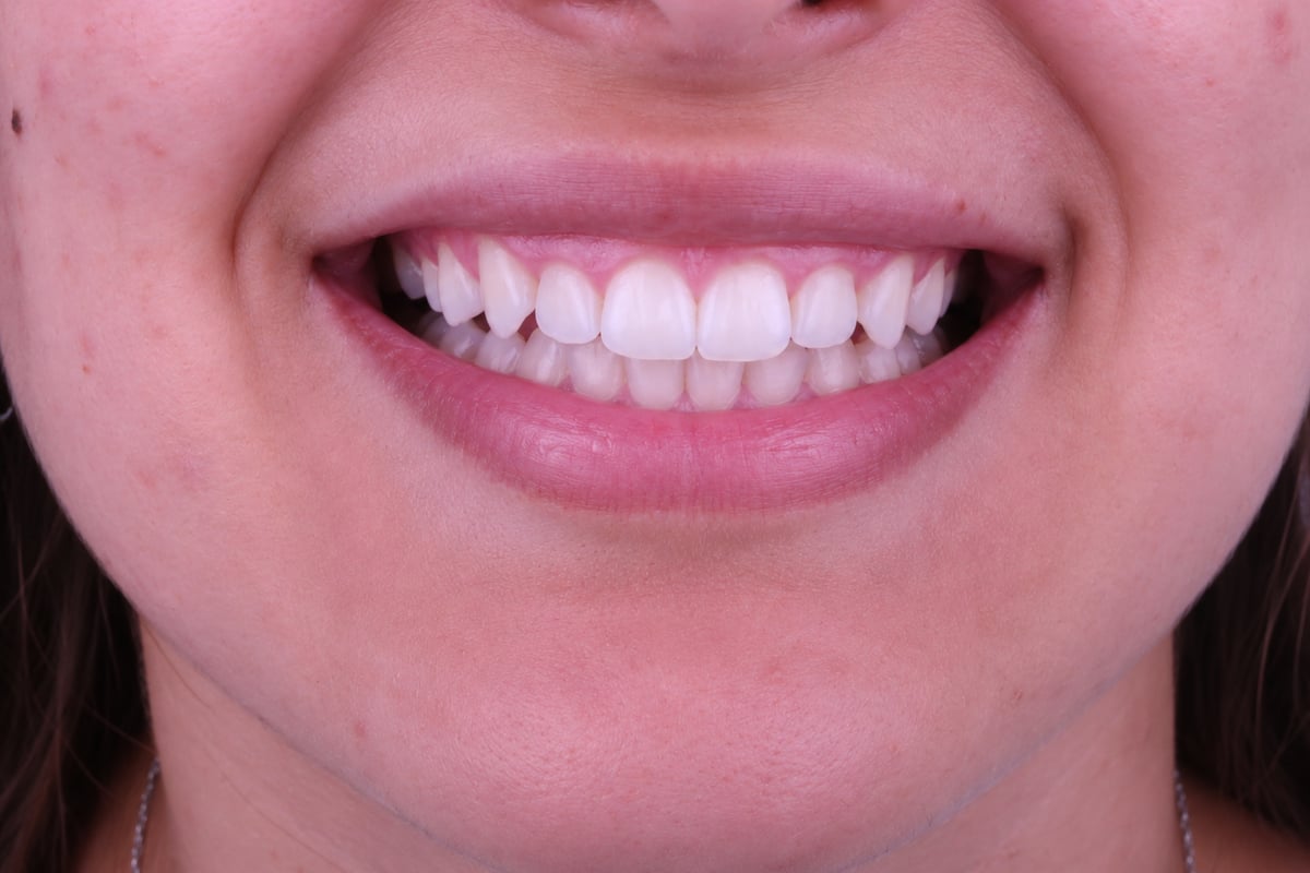 بعد - تجميل الابتسامة