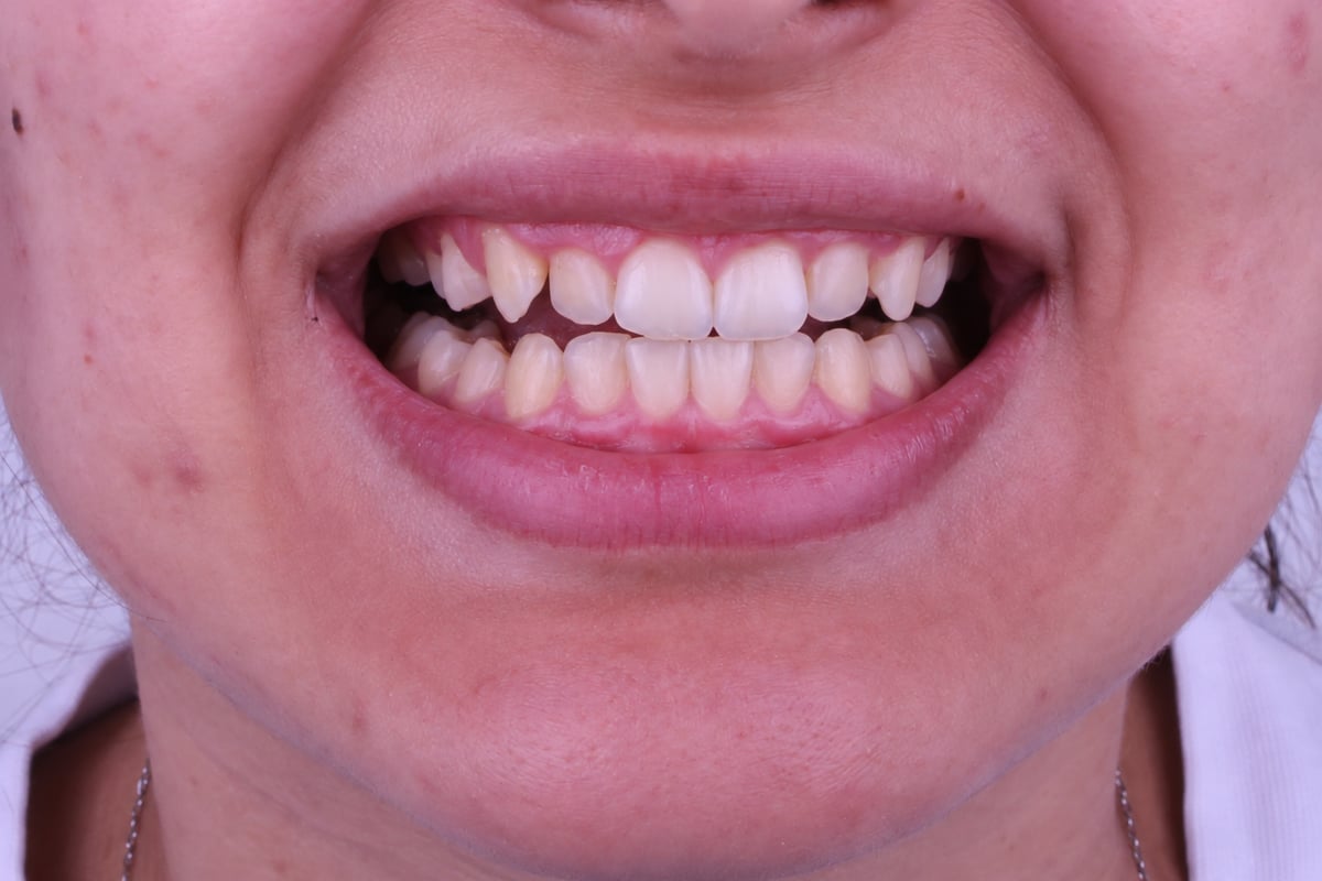 قبل - تجميل الابتسامة