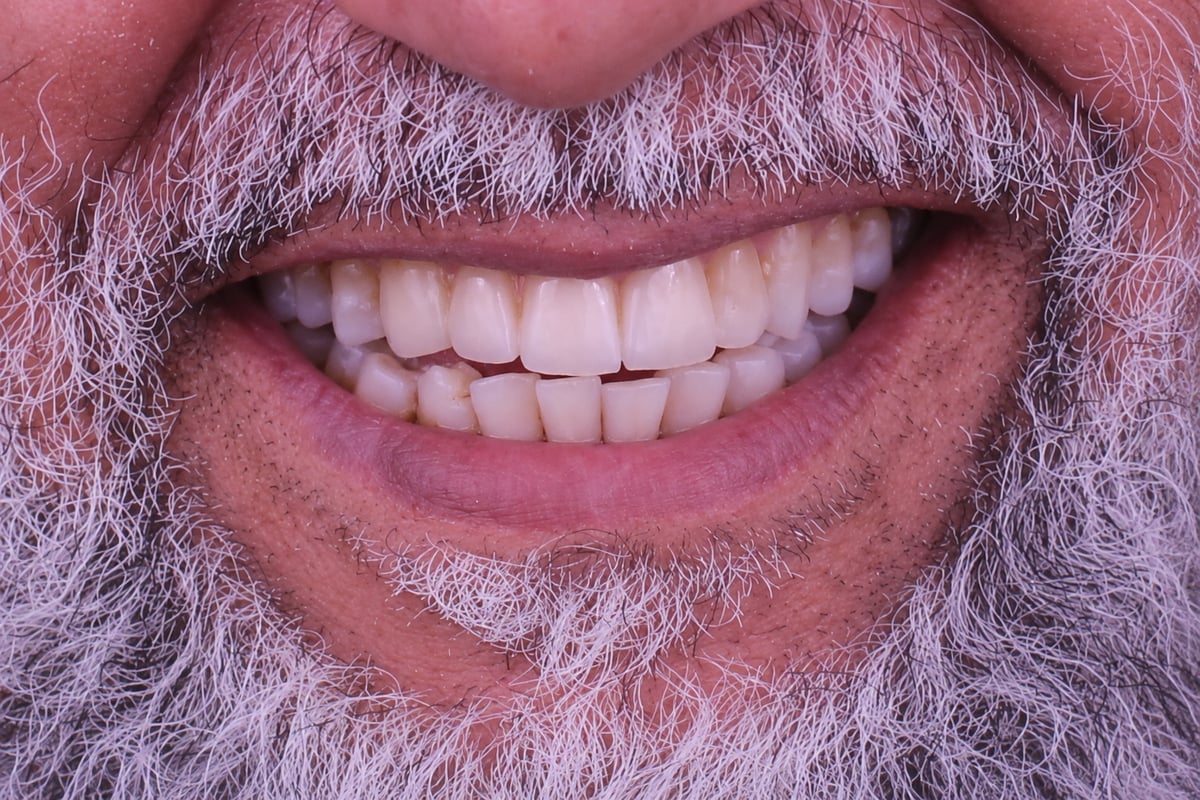 بعد - تعويض الأسنان المفقودة