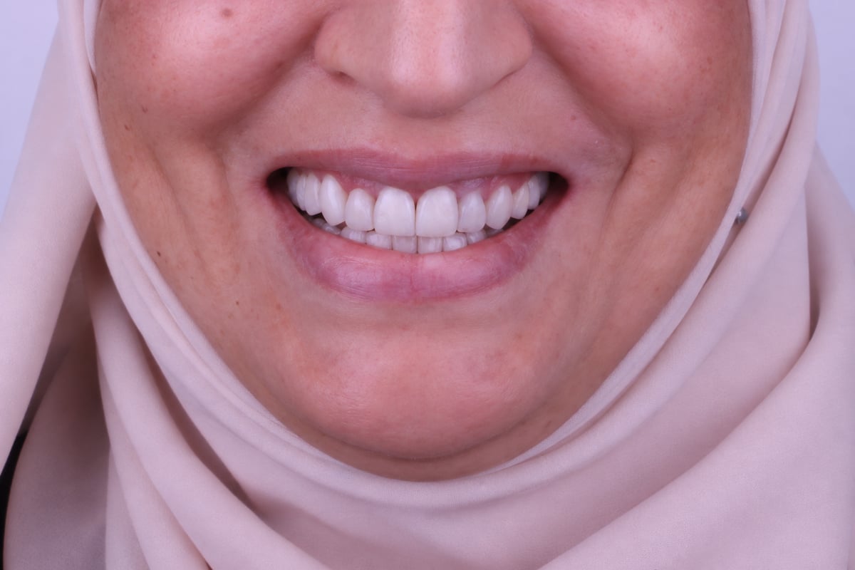 بعد - تجميل الابتسامة