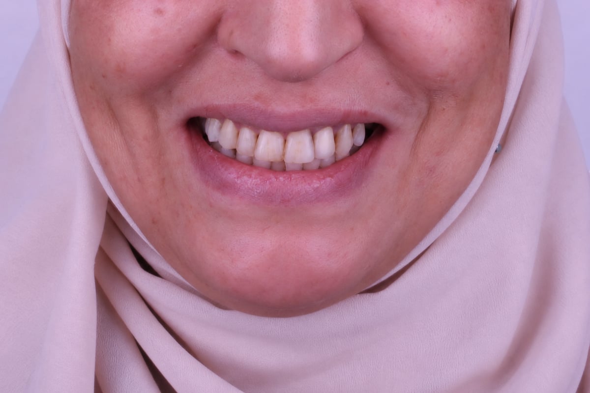 قبل - تجميل الابتسامة
