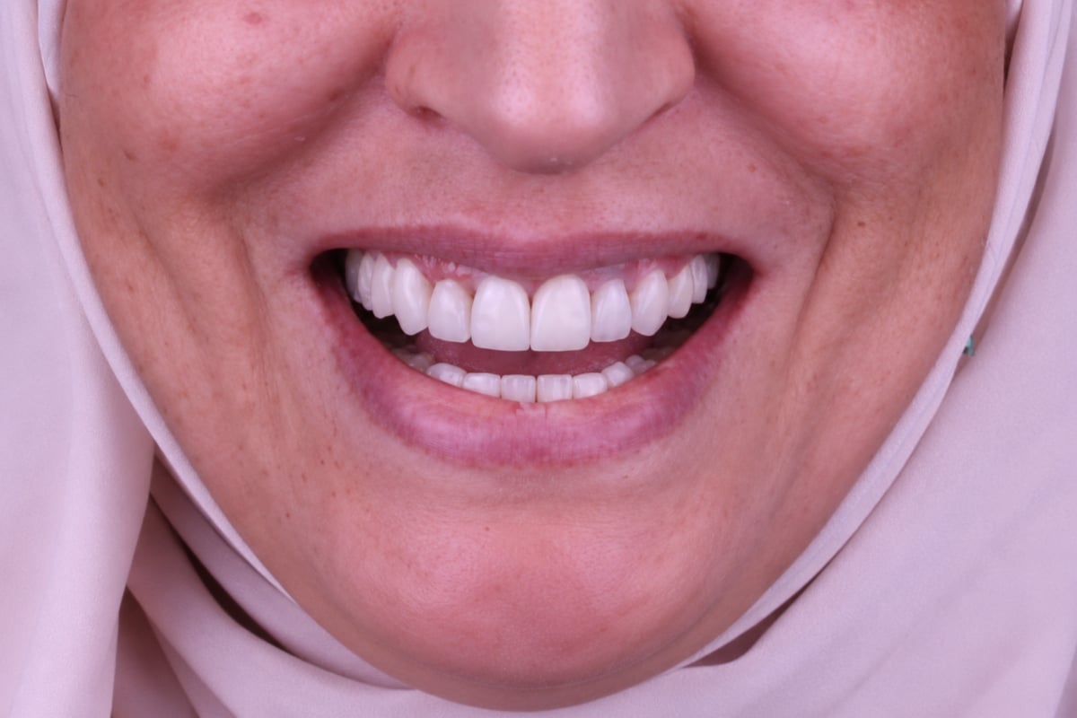 بعد - تجميل الابتسامة