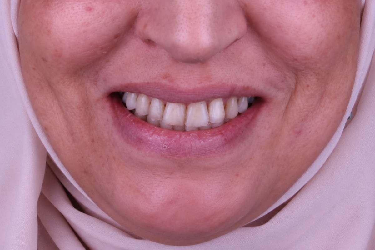 قبل - تجميل الابتسامة