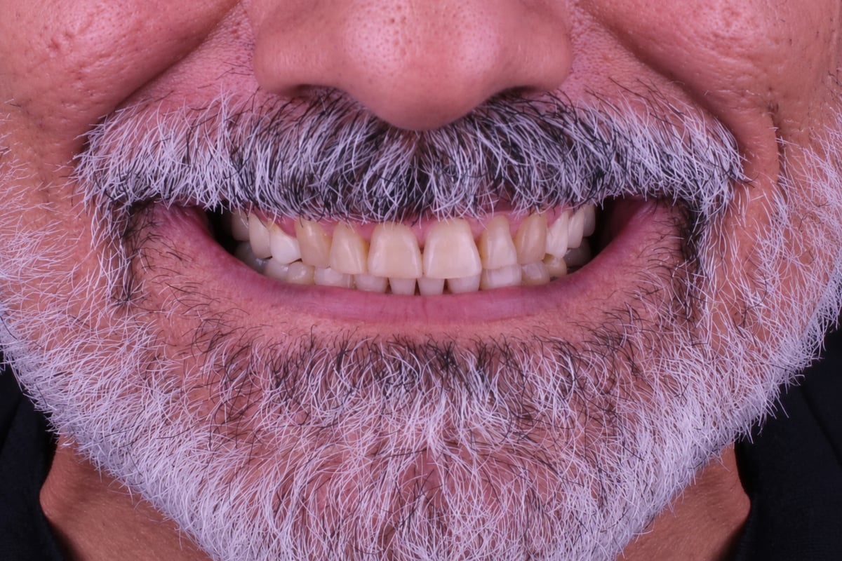 قبل - ابتسامة هوليوود