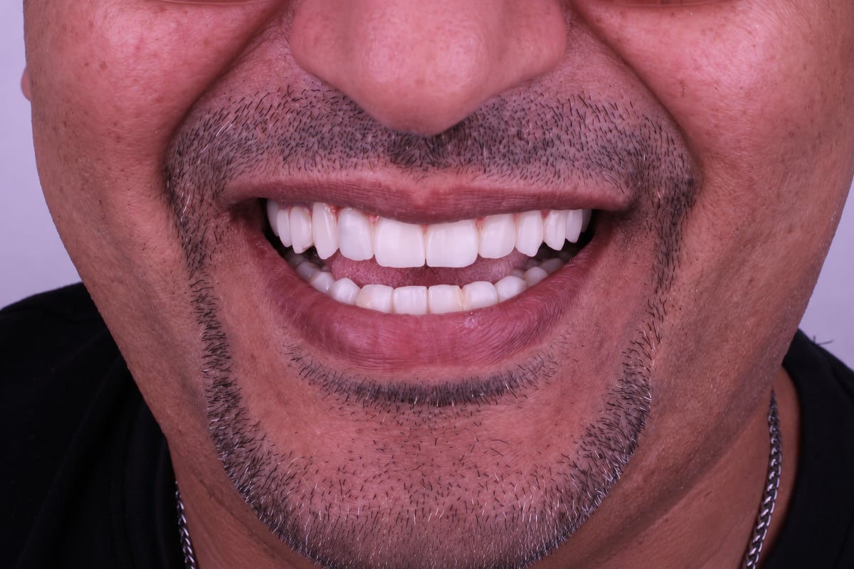 بعد - تركيبات كاملة